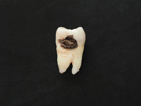 A cavity inside a tooth