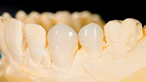 Veneers are place on the front part of your tooth only