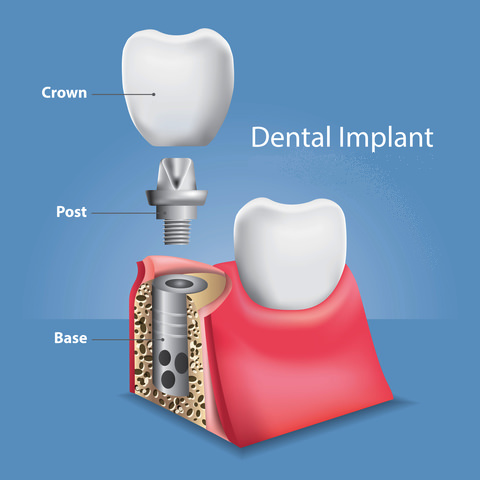 What a dental implant looks like