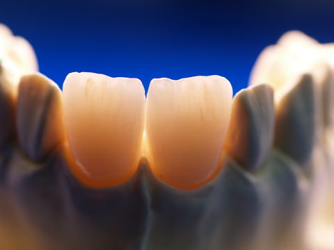 Front teeth with crowns