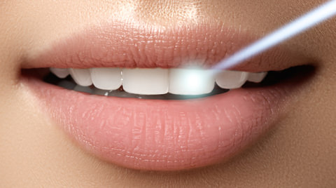 A lady with laserTeeth whitening