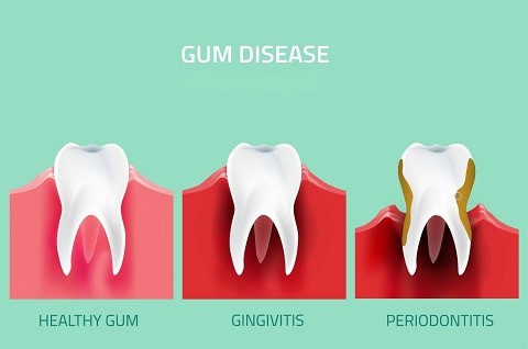 Gum disease stages