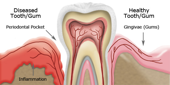 Diseased tooth/gum vs Healthy tooth/gum