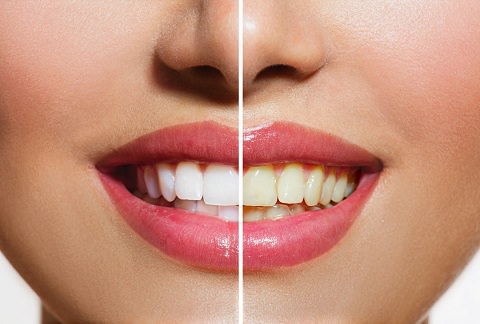 The difference teeth whitening makes