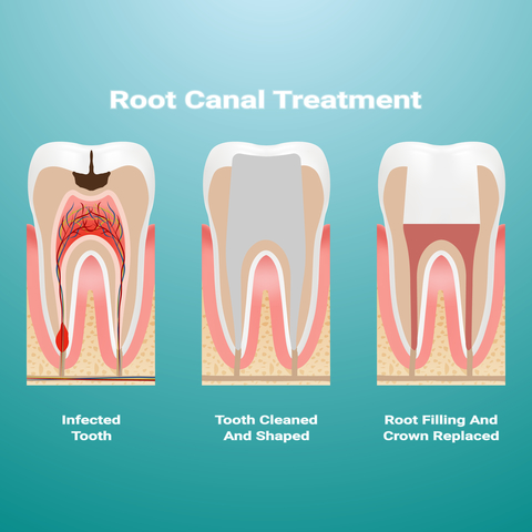 Stages of root canal treatment