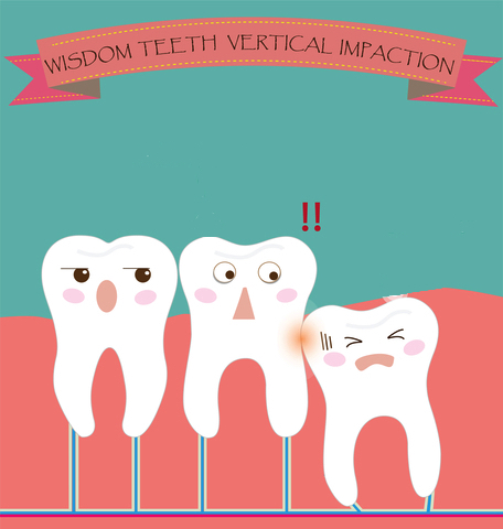 Wisdom teeth impaction