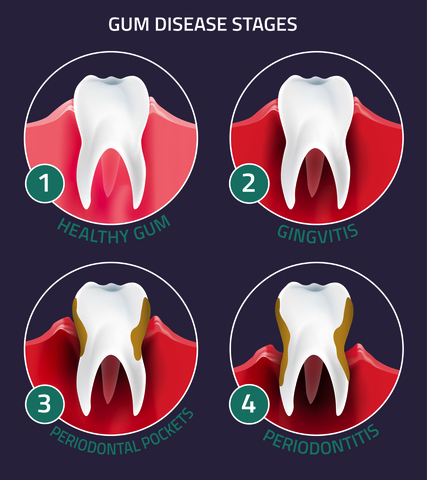 Gingivitis and gum disease stages