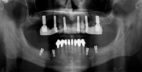 An X-ray of All-On- 4 Dental implant