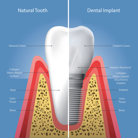 Natural tooth and dental implant comparison