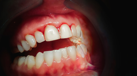 A person with gingivitis