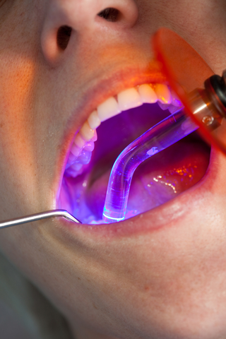 Laser treatment by a dentist