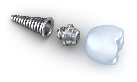 A dental implant in three pieces