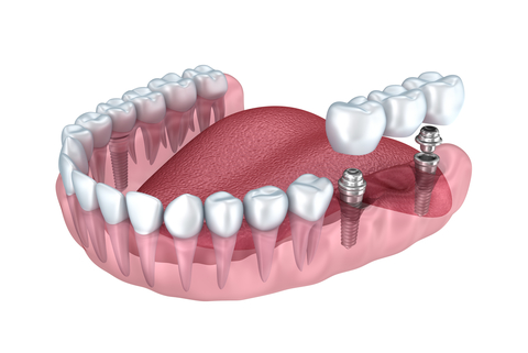 dental implant with the crown