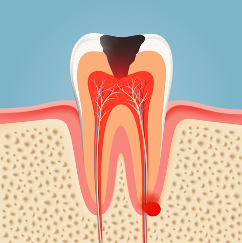 Illustration of a tooth abscess