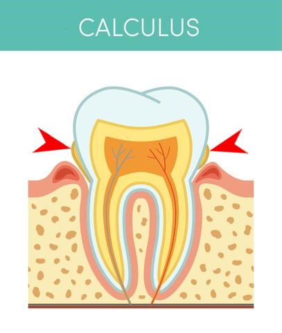 Calculus around your teeth