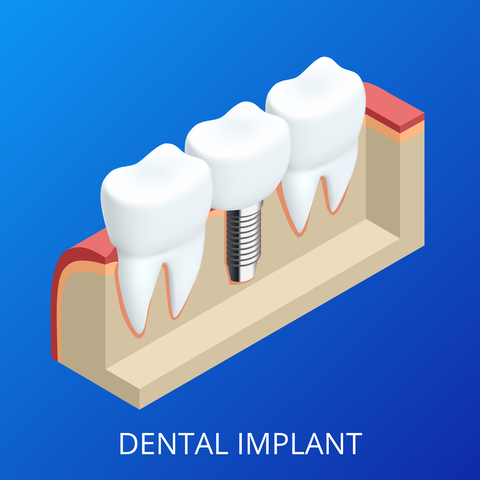 A dental implant that looks like the shape of a tooth