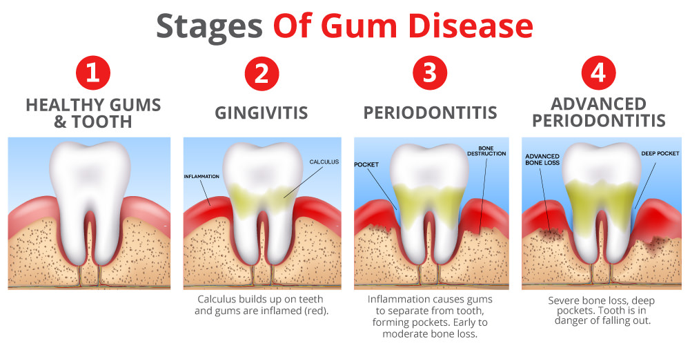 Stages of gum disease