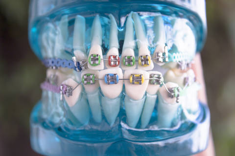 A image showing braces on teeth