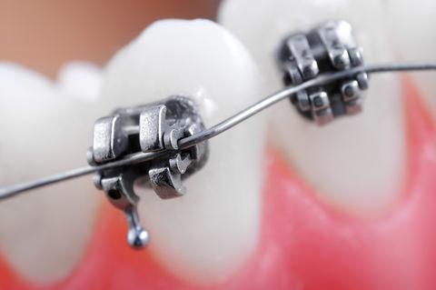 Braces that can cause swollen gums