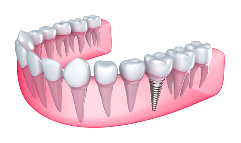 Dental implant illustration