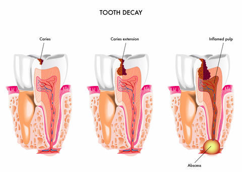 Tooth decay progression