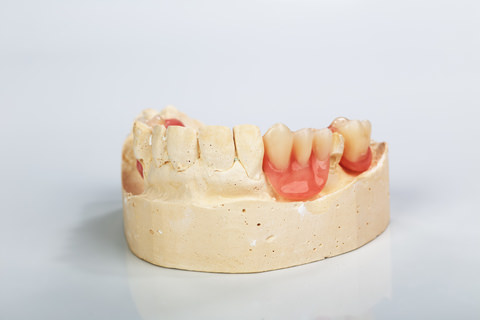 Partial dentures