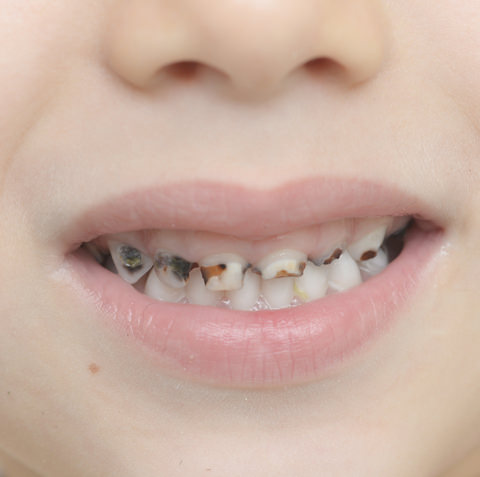 Tooth decay in a child