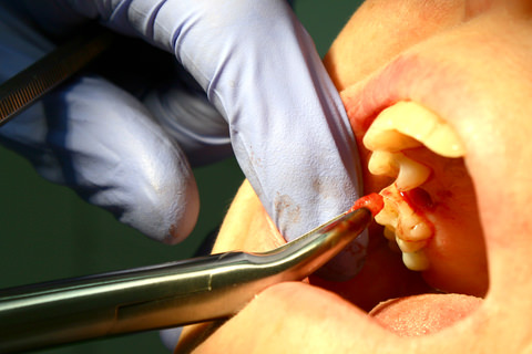Extracting an abscessed tooth