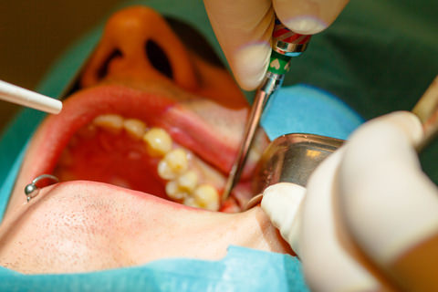 Surgical tooth extraction