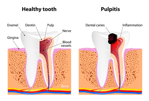 A tooth structure example showing a cavity