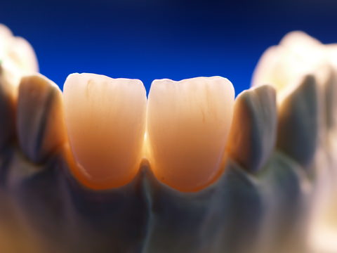 Front teeth with dental crowns