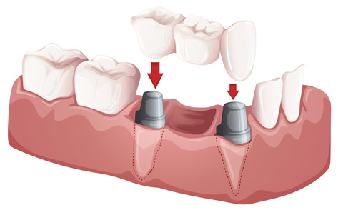 A illustration of a dental bridge