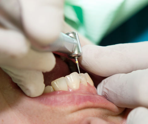 Preparing a tooth for a crown