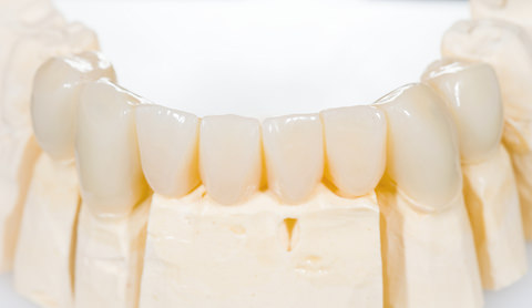 A dental bridge on a mould