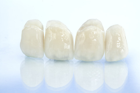 A dental bridge made up by crowns