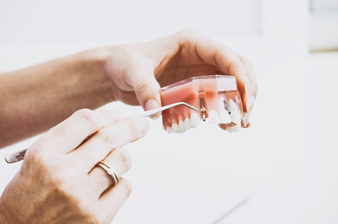 A person showing how a dental implant works