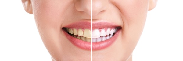 Professional teeth whitening before and after
