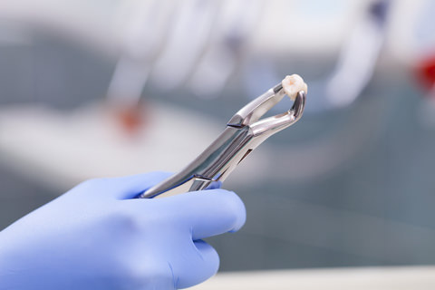 A tooth extraction