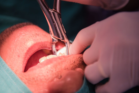 A man getting his tooth extracted