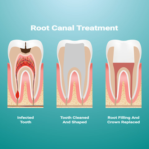 Root Canal Treatment illustration