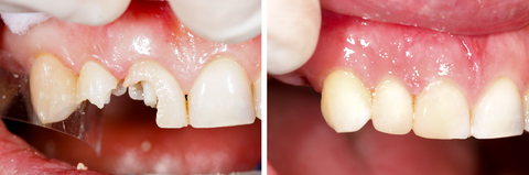 What Are Your Temporary Dental Filling Options? - Dental Aware Australia