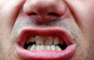 Plaque visible around teeth