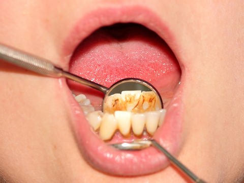 Plaque around teeth and gums