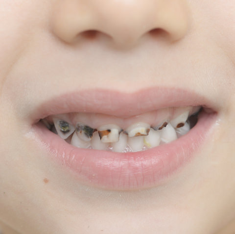 Tooth decay on baby teeth from sugary contents, poor diet and bad dental hygiene