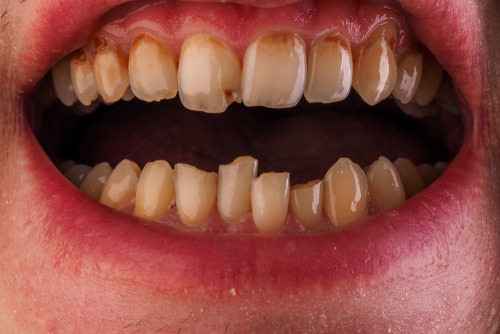 Tooth decay around gum line