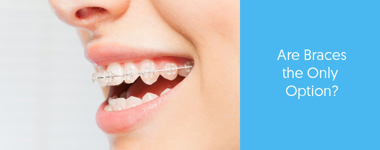 Do you need braces to fix crooked teeth? feature image