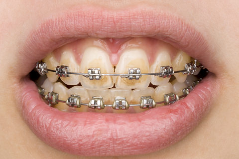 A person with braces that has demineralisation around their teeth
