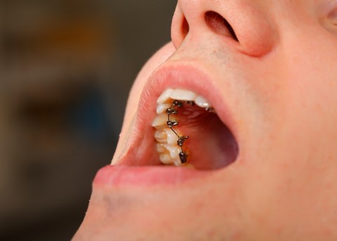 A man with lingual braces