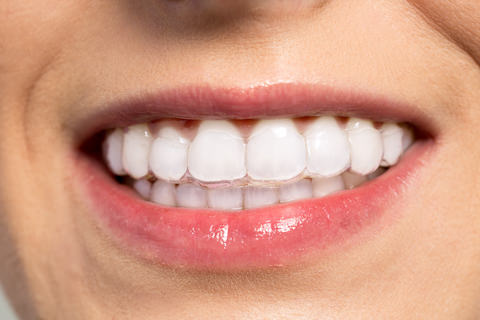 Clear Invisalign aligners