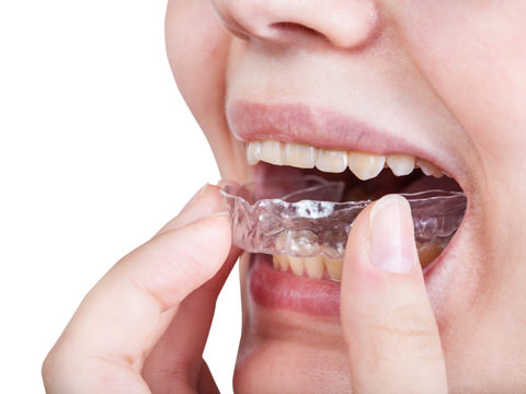 A lady using Invisalign to fix her crooked teeth